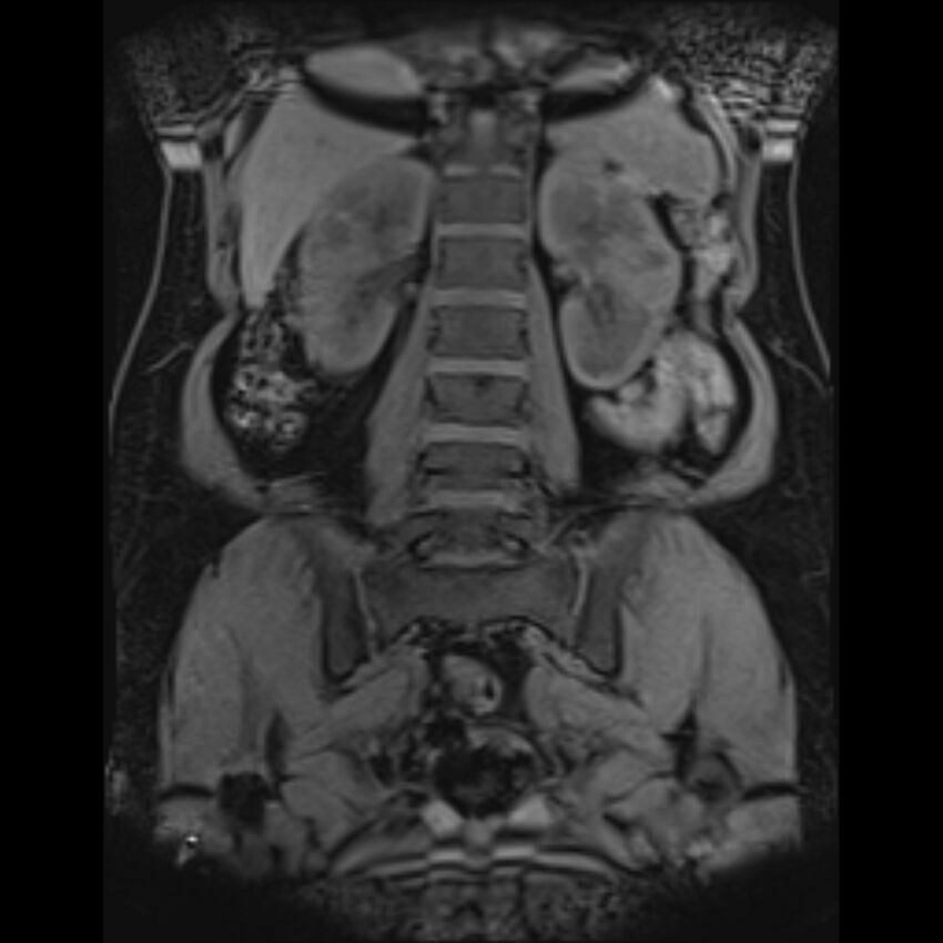 Bilobed placenta accreta (Radiopaedia 69648-79591 Coronal T1 vibe 118).jpg