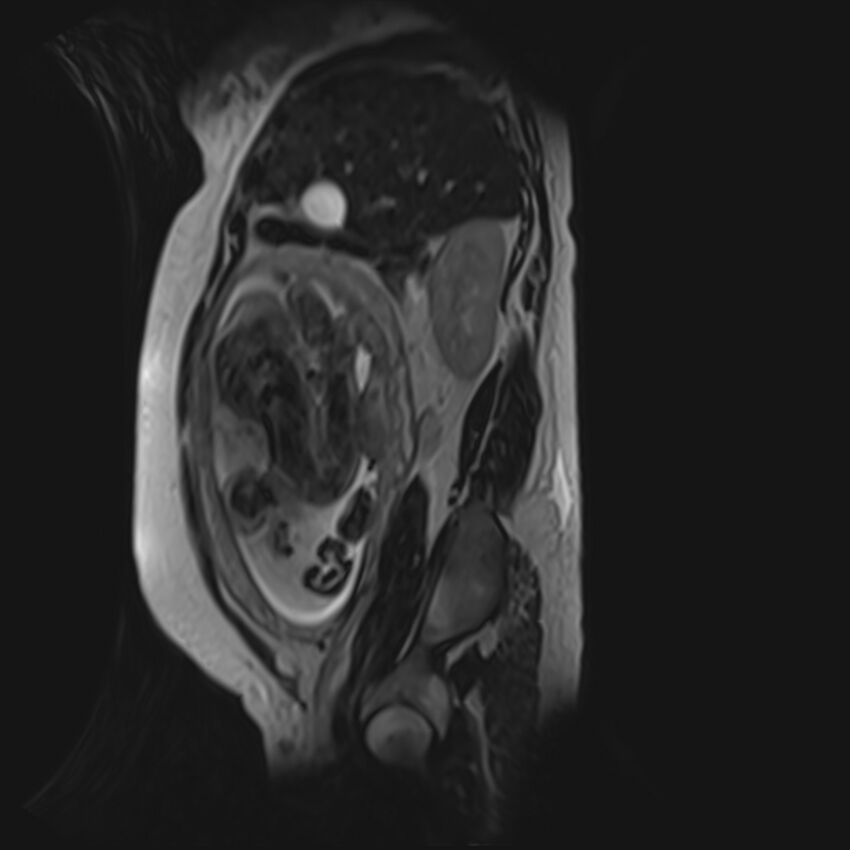 Bilobed placenta accreta (Radiopaedia 69648-79591 G 45).jpg