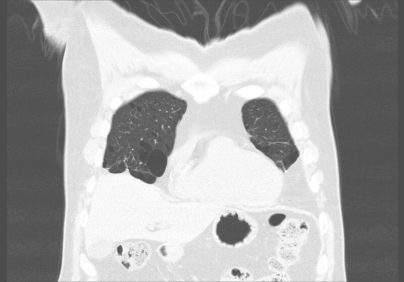 File:Birt-Hogg-Dubé syndrome (Radiopaedia 52578-58491 Coronal lung window 6).jpg