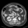 Bladder papillary urothelial carcinoma (Radiopaedia 48119-52951 Axial 20).png