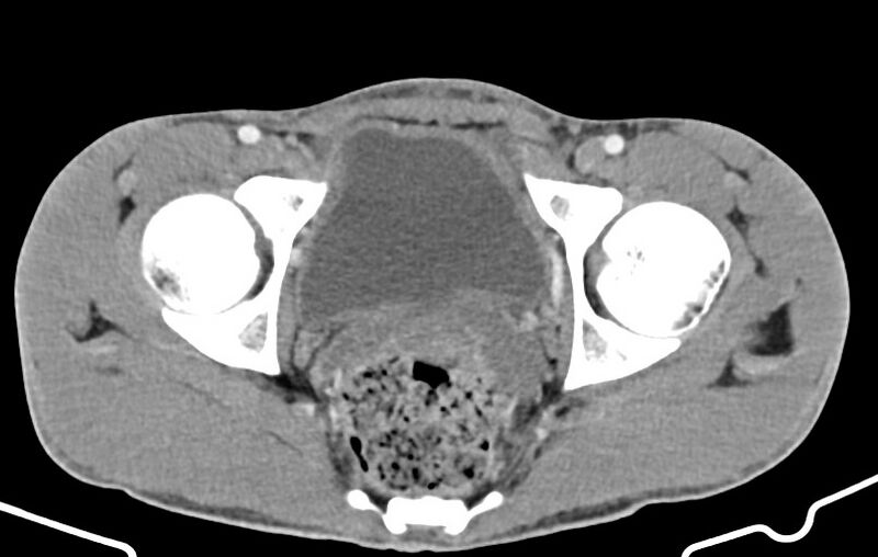 File:Blunt injury to the small bowel (Radiopaedia 74953-85987 A 181).jpg