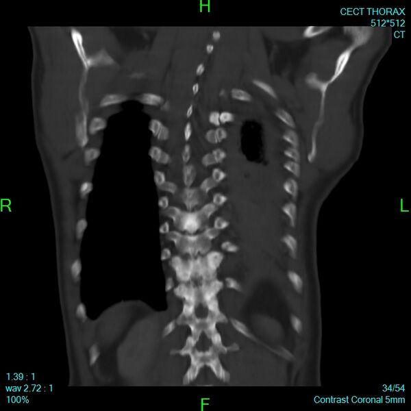 File:Bone metastases from lung carcinoma (Radiopaedia 54703-60937 Coronal bone window 34).jpg