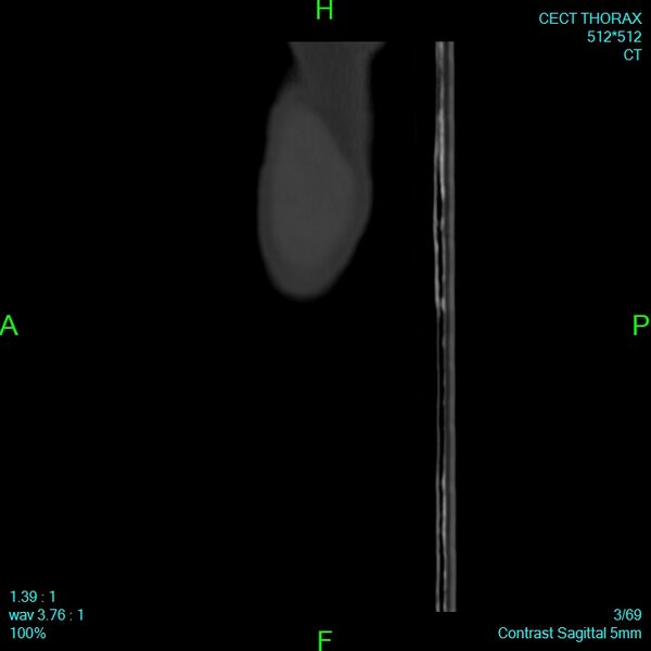 File:Bone metastases from lung carcinoma (Radiopaedia 54703-60937 Sagittal bone window 3).jpg