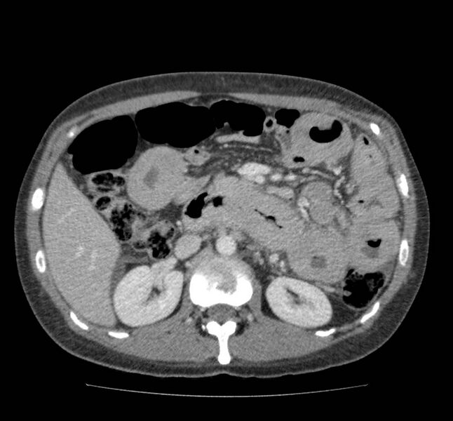 File:Bowel lymphoma complicated by bleeding after therapy (Radiopaedia 55601-62107 A 33).jpg