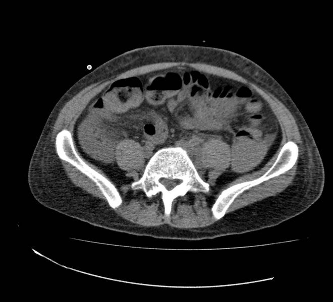 File:Bowel lymphoma complicated by bleeding after therapy (Radiopaedia 55601-62110 Axial non-contrast 56).jpg
