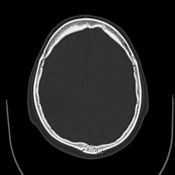 File:Brain Pantopaque remnants (Radiopaedia 78403-91048 Axial bone window 48).jpg