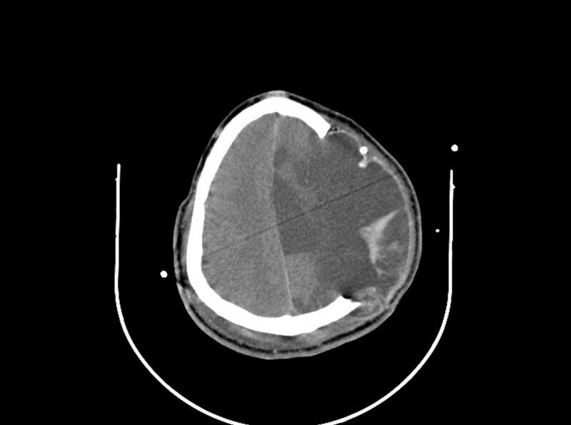 File:Brain injury by firearm projectile (Radiopaedia 82068-96087 B 142).jpg