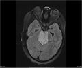 Brainstem glioma (Radiopaedia 21819-21775 Axial FLAIR 14).jpg
