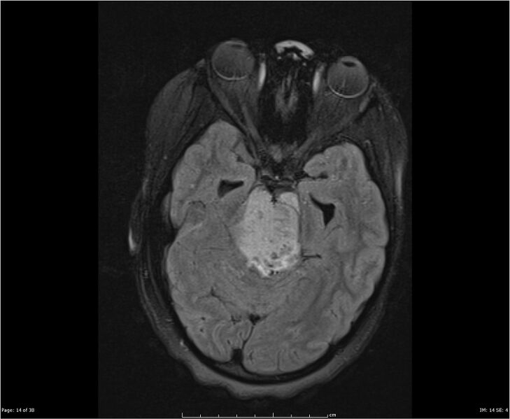 File:Brainstem glioma (Radiopaedia 21819-21775 Axial FLAIR 14).jpg