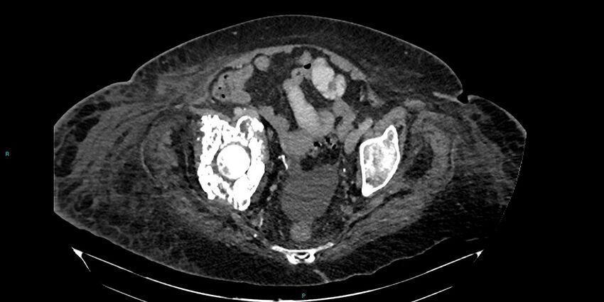 Breast cancer pelvic bony metastases (Radiopaedia 84470-99824 Axial bone window 49).jpg