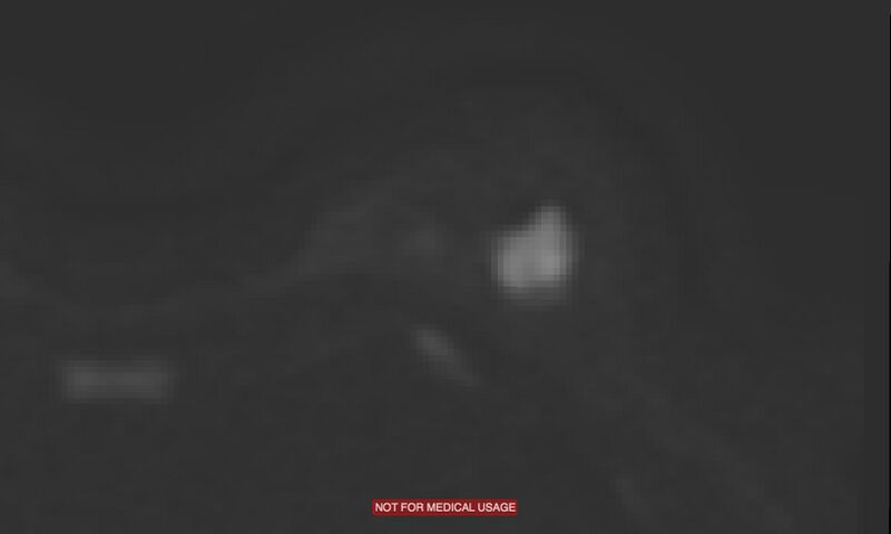 File:Breast lymphoma (MRI) (Radiopaedia 34999-36498 Axial DWI 10).jpg