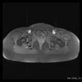 Broad ligament fibroid (Radiopaedia 49135-54241 Axial T1 fat sat 24).jpg