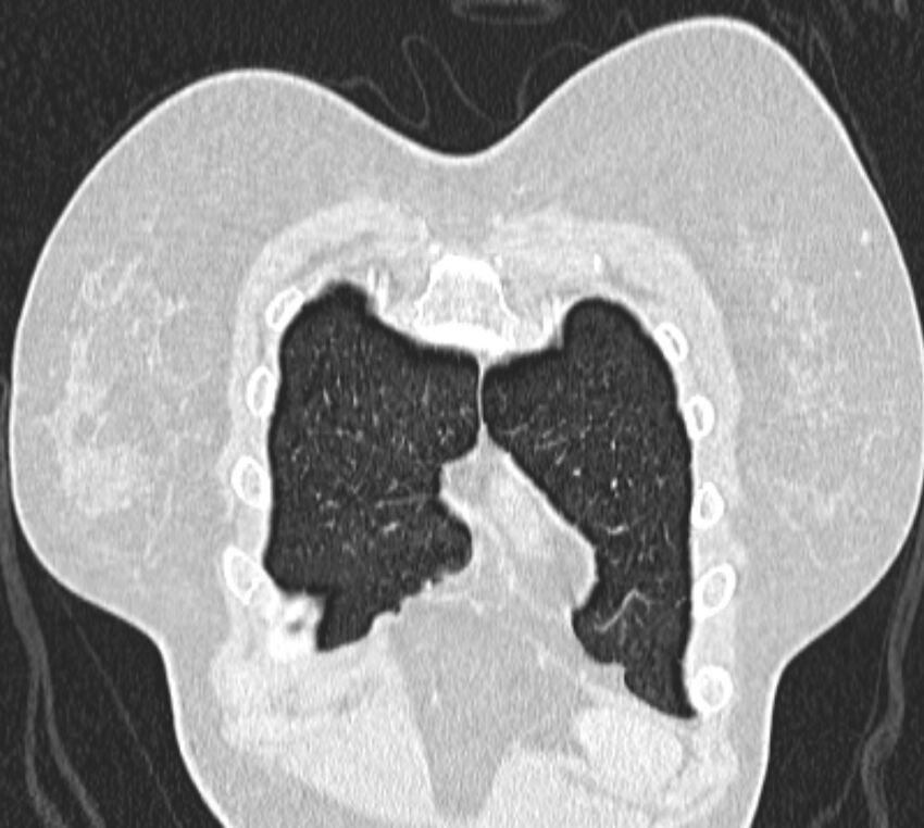 Bronchial atresia (Radiopaedia 50007-55297 Coronal lung window 4).jpg
