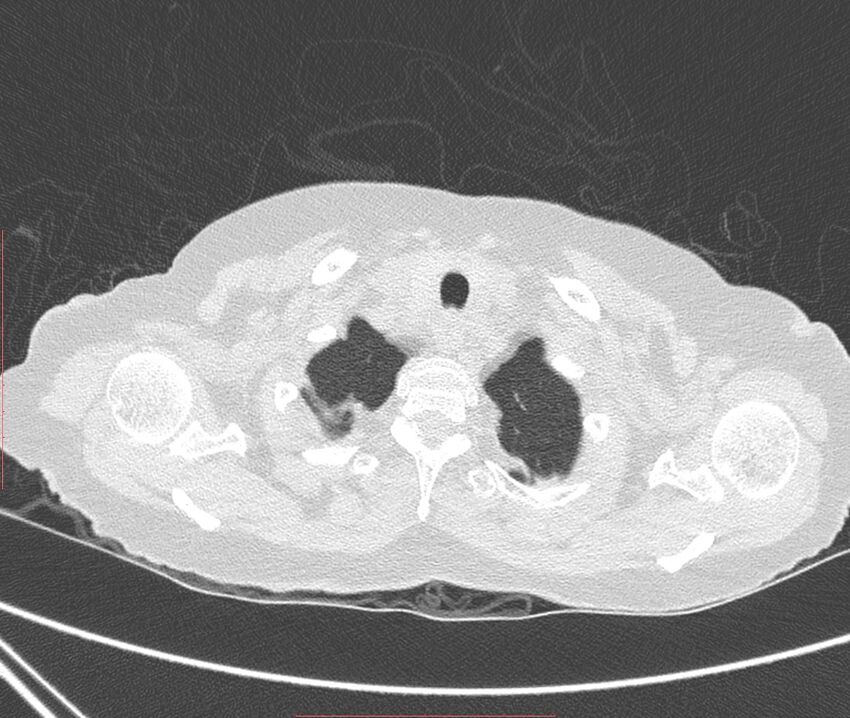 Bronchiectasis (Radiopaedia 72693-83293 Axial lung window 4).jpg