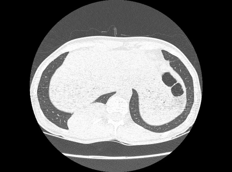 File:Bronchogenic cyst (Radiopaedia 80273-93615 Axial lung window 34).jpg