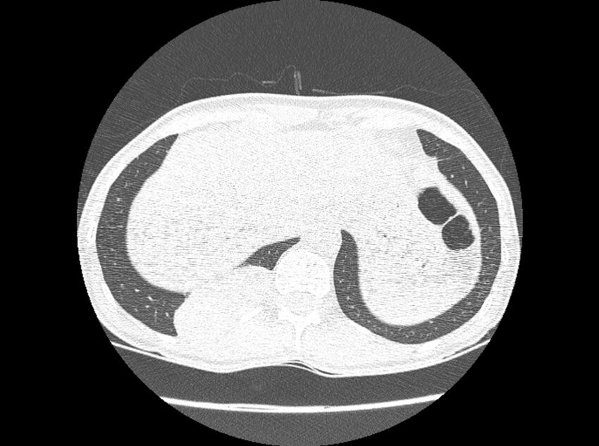 Bronchogenic cyst (Radiopaedia 80273-93615 Axial lung window 34).jpg