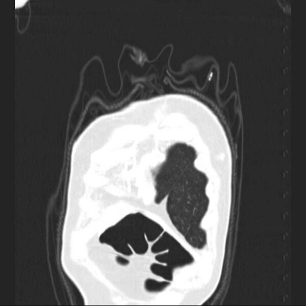 File:Bronchopleural fistula - postoperative complication (Radiopaedia 21020-20947 Coronal lung window 2).jpg
