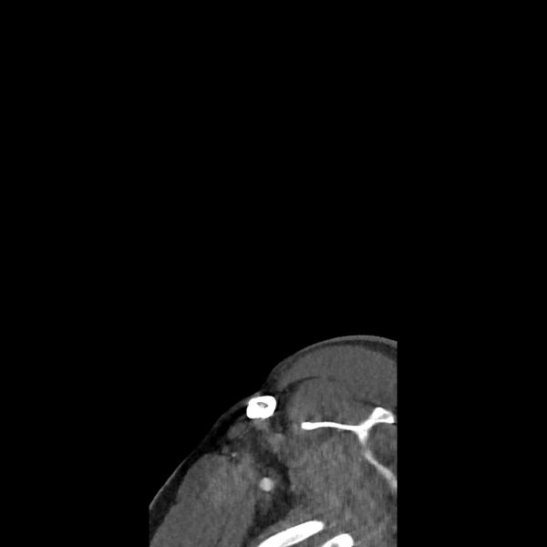 File:Buccal fat pad arteriovenous malformation (Radiopaedia 70936-81144 C 6).jpg