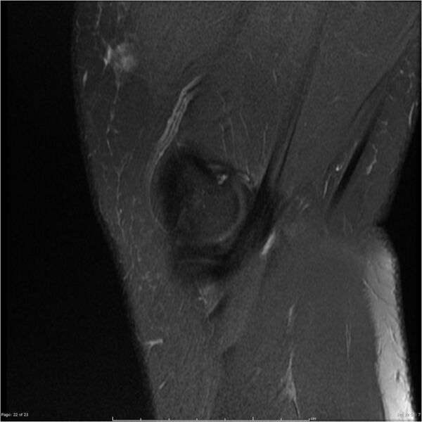 File:Bucket handle tear - lateral meniscus (Radiopaedia 7246-8187 Sagittal T2 fat sat 22).jpg