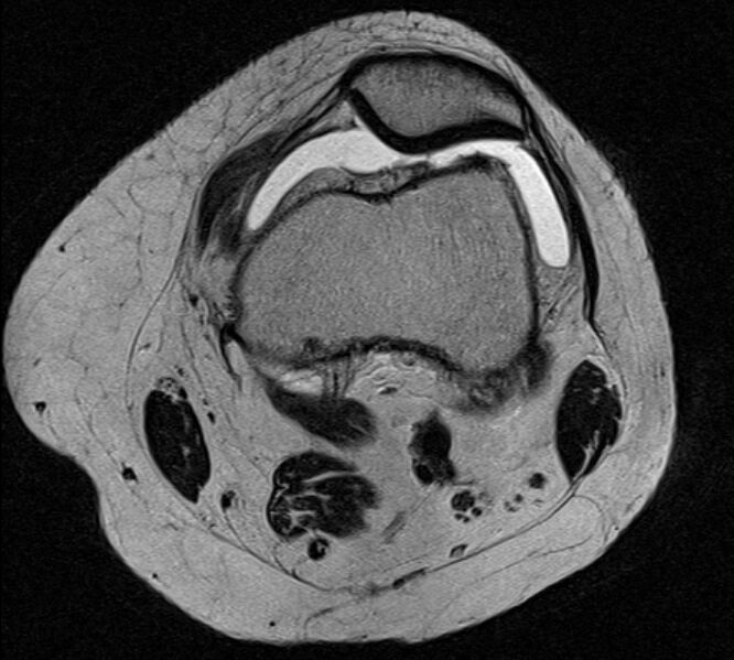 File:Bucket handle tear - medial meniscus (Radiopaedia 79028-91942 Axial T2 22).jpg