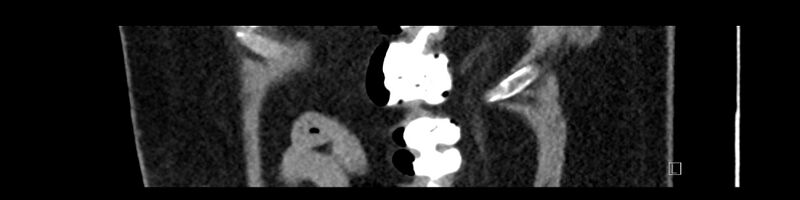 File:Buried bumper syndrome - gastrostomy tube (Radiopaedia 63843-72575 Sagittal Inject 13).jpg
