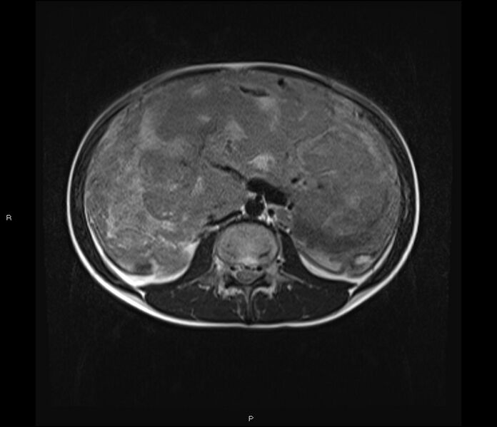 File:Burkitt lymphoma (bowel) (Radiopaedia 68839-78557 Axial T2 32).jpg