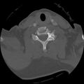 C1 anterior arch (plough) fracture - type 1 (Radiopaedia 76181-87720 Axial bone window 57).jpg
