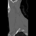 C5 facet fracture (Radiopaedia 58374-65499 Sagittal bone window 12).jpg