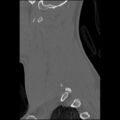 C5 facet fracture (Radiopaedia 58374-65499 Sagittal bone window 55).jpg