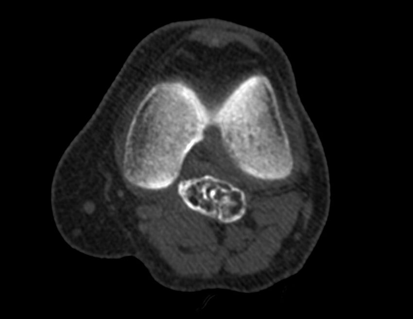Calcified hematoma - popliteal fossa (Radiopaedia 63938-72763 Axial bone window 14).jpg