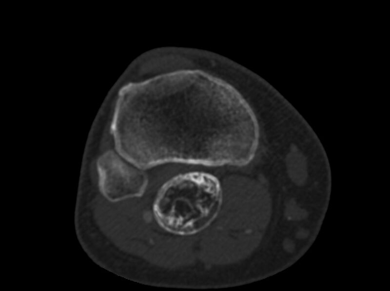 File:Calcified hematoma - popliteal fossa (Radiopaedia 63938-72763 C 61).jpg