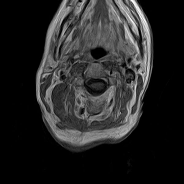 File:Calcified meningioma - cervical canal (Radiopaedia 70136-82468 Axial T1 C+ 14).jpg
