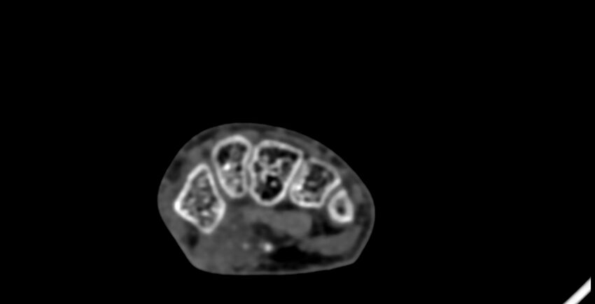 Calcifying aponeurotic fibroma (Radiopaedia 88423-105064 B 94).jpg
