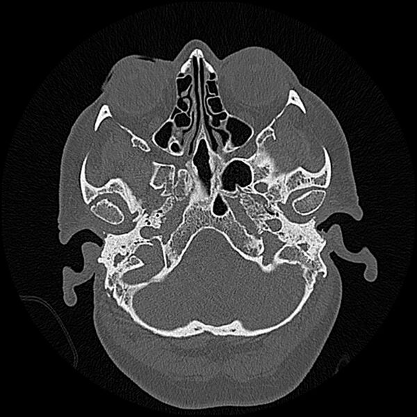 File:Canal up mastoidectomy (Radiopaedia 78108-90638 Axial bone window 37).jpg