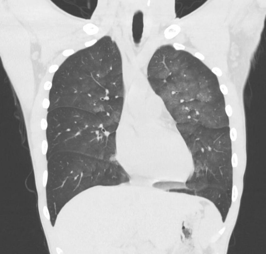 Cannabis-induced diffuse alveolar hemorrhage (Radiopaedia 89834-106946 Coronal lung window 58).jpg