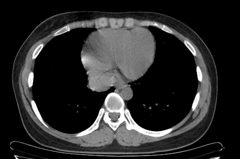 File:Cannonball metastases - uterine choriocarcinoma (Radiopaedia 70137-80173 Axial non-contrast 89).jpg