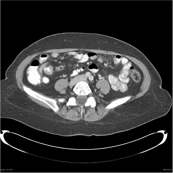 File:Carcinoid tumor of the ileum with metastasis to orbit (Radiopaedia 28165-28425 A 14).jpg