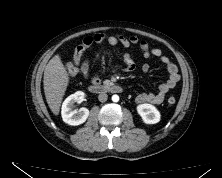 Carcinoid tumor with hepatic metastases (Radiopaedia 22651-22670 B 41).jpg