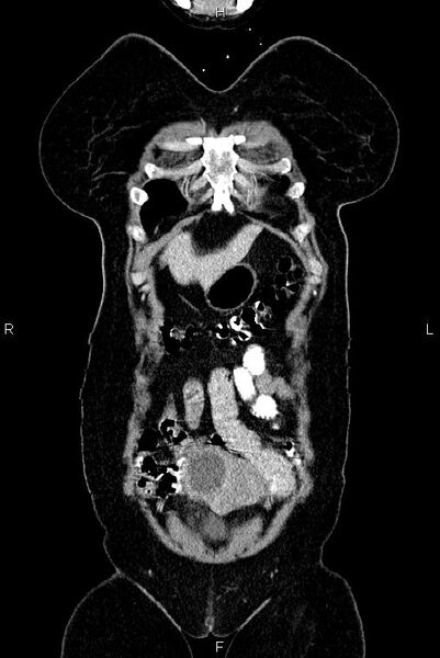 File:Carcinoma of uterine cervix (Radiopaedia 85861-101700 C 2).jpg
