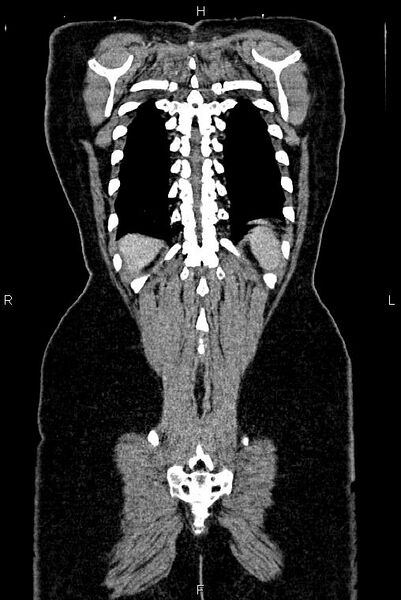 File:Carcinoma of uterine cervix (Radiopaedia 85861-101700 C 53).jpg