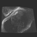 Cardiac fibroma (Radiopaedia 38974-41150 4 chamber FGRET 22).jpg