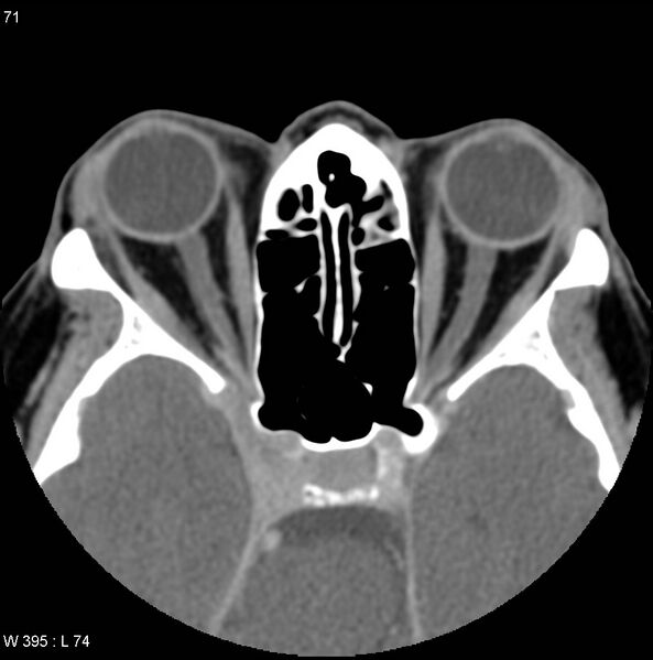 File:Caroticocavernous fistula (indirect) (Radiopaedia 4083-6560 Axial liver window 1).jpg