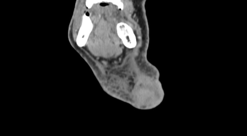 File:Carotid artery pseudoaneurysm (Radiopaedia 84030-99259 D 1).jpg