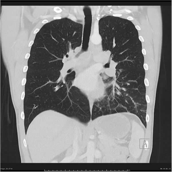File:Cavitating lung cancer (Radiopaedia 25796-25945 lung window 22).jpg