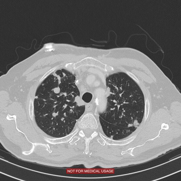 File:Cavitating pulmonary metastases (Radiopaedia 24920-25184 Axial lung window 4).jpg