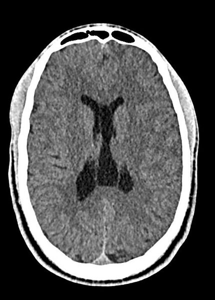 File:Cavum septum pellucidum and cavum vergae (Radiopaedia 77797-90060 Axial Brain Window 61).jpg