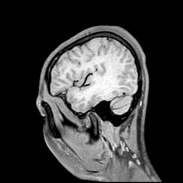 File:Central neurocytoma (Radiopaedia 79320-92380 Sagittal T1 209).jpg