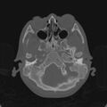 Cerebellar abscess secondary to mastoiditis (Radiopaedia 26284-26413 Axial bone window 32).jpg
