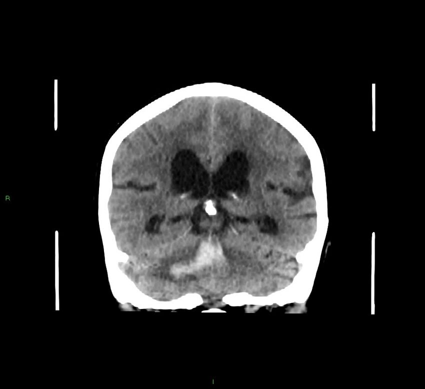 Cerebellar hemorrhage (Radiopaedia 58793-66027 Coronal non-contrast 29).jpg