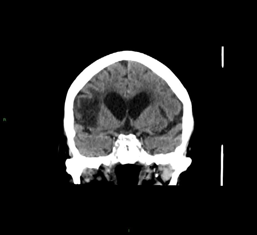 Cerebellar hemorrhage (Radiopaedia 58793-66027 Coronal non-contrast 43).jpg